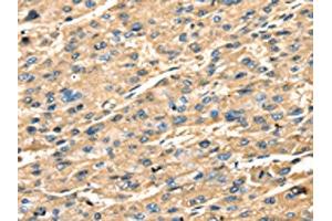 The image on the left is immunohistochemistry of paraffin-embedded Human liver cancer tissue using ABIN7131239(STX18 Antibody) at dilution 1/25, on the right is treated with fusion protein. (Syntaxin 18 antibody)