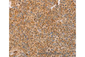 Immunohistochemistry of Human cervical cancer using BRS3 Polyclonal Antibody at dilution of 1:30 (BRS3 antibody)
