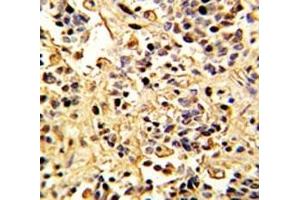 IHC analysis of FFPE human kidney carcinoma with Neprilysin antibody (MME antibody  (AA 506-534))