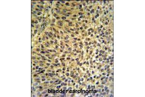 FUT6 Antibody IHC analysis in formalin fixed and paraffin embedded bladder carcinoma followed by peroxidase conjugation of the secondary antibody and DAB staining. (FUT6 antibody  (AA 102-130))