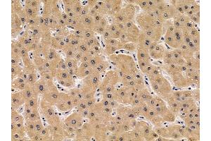 ABIN6256932 and ABIN6275042 at 1/100 staining human liver cancer by IHC-P. (Coxsackie Adenovirus Receptor antibody  (N-Term))