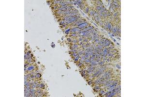 Immunohistochemistry of paraffin-embedded human colon carcinoma using ALDH1A1 antibody (ABIN5970911) at dilution of 1/100 (40x lens). (ALDH1A1 antibody)