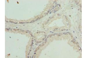 Immunohistochemistry of paraffin-embedded human prostate cancer using ABIN7164554 at dilution of 1:100