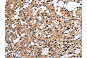 The image on the left is immunohistochemistry of paraffin-embedded Human thyroid cancer tissue using ABIN7128963(CLEC2D Antibody) at dilution 1/70, on the right is treated with fusion protein. (CLEC2D antibody)