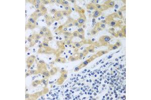 Immunohistochemistry of paraffin-embedded human liver cancer using SHBG antibody (ABIN6129327, ABIN6147736, ABIN6147737 and ABIN6223329) at dilution of 1:100 (40x lens). (SHBG antibody  (AA 30-170))