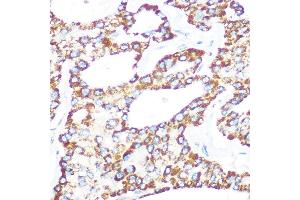 Immunohistochemistry of paraffin-embedded human lung cancer using γ-Catenin Rabbit mAb (ABIN1683043, ABIN3018625, ABIN3018626 and ABIN7101634) at dilution of 1:100 (40x lens). (JUP antibody)