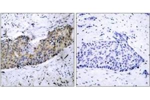 Immunohistochemistry analysis of paraffin-embedded human breast carcinoma tissue, using VEGFR2 (Ab-1214) Antibody.