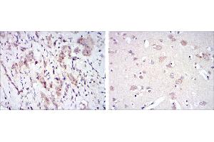 Immunohistochemical analysis of paraffin-embedded breast cancer tissues (left) and brain tissues (right) using FYN mouse mAb with DAB staining. (FYN antibody)