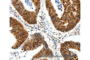 Immunohistochemistry of Human ovarian cancer using SP1 Polyclonal Antibody at dilution of 1:30 (SP1 antibody)