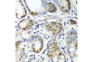 Immunohistochemistry of paraffin-embedded human colon carcinoma using CRYAA antibody at dilution of 1:200 (40x lens). (CRYAA antibody)