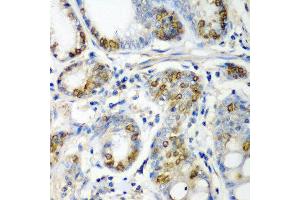 Immunohistochemistry of paraffin-embedded human colon carcinoma using CRYAA antibody at dilution of 1:200 (40x lens).