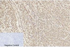 Immunohistochemical analysis of paraffin-embedded human uterus cancer tissue. (TUBB1 antibody)
