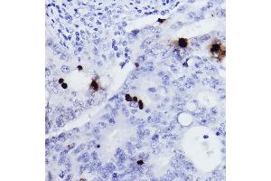 Immunohistochemistry of paraffin-embedded human colon carcinoma using Phospho-Histone H3-S10 Rabbit pAb (ABIN7267687) at dilution of 1:2000 (40x lens).