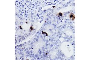 Immunohistochemistry of paraffin-embedded human colon carcinoma using Phospho-Histone H3-S10 Rabbit pAb (ABIN7267687) at dilution of 1:2000 (40x lens). (Histone 3 antibody  (H3S10p))