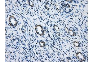 Immunohistochemical staining of paraffin-embedded Adenocarcinoma of breast tissue using anti-ACO2 mouse monoclonal antibody.