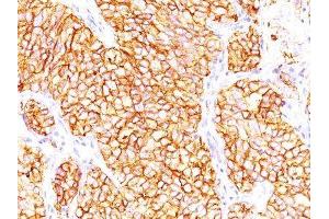 Image no. 1 for anti-Proximal-Nephrogenic Antigen / Renal Cell Carcinoma (RCC) antibody (ABIN6153756) (Proximal-Nephrogenic Antigen / Renal Cell Carcinoma (RCC) antibody)
