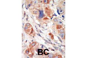 Formalin-fixed and paraffin-embedded human cancer tissue reacted with PIK3CD polyclonal antibody  , which was peroxidase-conjugated to the secondary antibody, followed by DAB staining. (PIK3CD antibody  (C-Term))