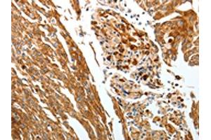 The image on the left is immunohistochemistry of paraffin-embedded Human cervical cancer tissue using ABIN7192428(SLC22A3 Antibody) at dilution 1/25, on the right is treated with synthetic peptide.
