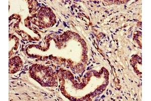 Immunohistochemistry of paraffin-embedded human prostate cancer using ABIN7165494 at dilution of 1:100 (FAM3B antibody  (AA 31-235))