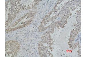 Immunohistochemistry (IHC) analysis of paraffin-embedded Human Lung Carcicnoma using Mouse Monoclonal Antibody diluted at 1:500. (HSP70 antibody)
