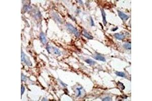 IHC analysis of FFPE human breast carcinoma tissue stained with the ISG15 antibody (ISG15 antibody  (AA 31-61))