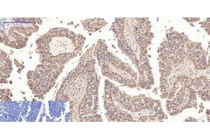 Immunohistochemistry of paraffin-embedded Human lung cancer tissue using CA9 Monoclonal Antibody at dilution of 1:200. (CA9 antibody)