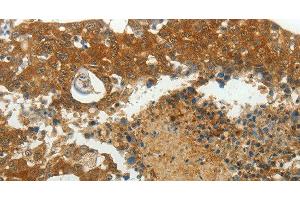 Immunohistochemistry of paraffin-embedded Human breast cancer using MCM4 Polyclonal Antibody at dilution of 1:40 (MCM4 antibody)