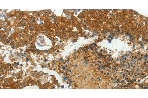 Immunohistochemistry of paraffin-embedded Human breast cancer using MCM4 Polyclonal Antibody at dilution of 1:40 (MCM4 antibody)