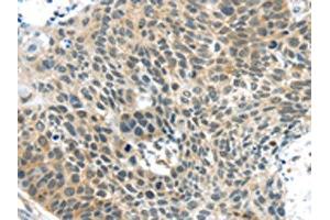 The image on the left is immunohistochemistry of paraffin-embedded Human esophagus cancer tissue using ABIN7192941(TSPY1 Antibody) at dilution 1/40, on the right is treated with synthetic peptide. (TSPY1 antibody)