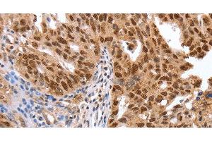 Immunohistochemistry of paraffin-embedded Human ovarian cancer using PARP1 Polyclonal Antibody at dilution of 1:40 (PARP1 antibody)