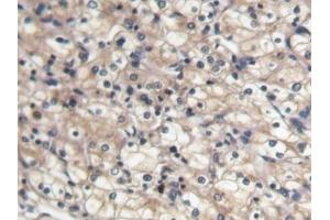 DAB staining on IHC-P; Samples: Human Renal cancer Tissue (BMP7 antibody  (AA 30-431))