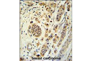 FBXL15 Antibody immunohistochemistry analysis in formalin fixed and paraffin embedded human breast carcinoma followed by peroxidase conjugation of the secondary antibody and DAB staining. (FBXL15 antibody  (C-Term))