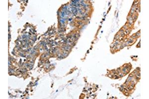 The image on the left is immunohistochemistry of paraffin-embedded Human colon cancer tissue using ABIN7128332(AKR1D1 Antibody) at dilution 1/35, on the right is treated with fusion protein. (AKR1D1 antibody)