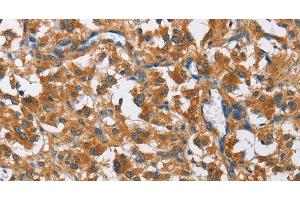 Immunohistochemistry of paraffin-embedded Human thyroid cancer using COPB1 Polyclonal Antibody at dilution of 1:50