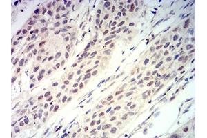 Immunohistochemical analysis of paraffin-embedded esophageal cancer tissues using RUNX3 mouse mAb with DAB staining. (RUNX3 antibody  (AA 294-429))