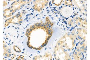 ABIN6265126 and ABIN6272496 at 1/100 staining Human kidney cancer and adjacent normal tissues by IHC-P. (SLC30A2 antibody  (Internal Region))
