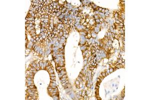 Immunohistochemistry of paraffin-embedded Human colon carcinoma using CD147/BSG antibody (ABIN7265838) at dilution of 1:100 (40x lens). (CD147 antibody)