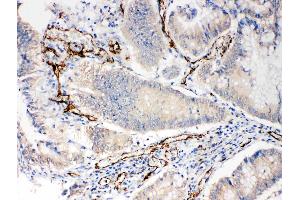 Anti-CD31 antibody, IHC(P): Human Intestinal Cancer Tissue (CD31 antibody  (C-Term))