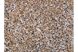 The image on the left is immunohistochemistry of paraffin-embedded Human prostate cancer tissue using ABIN7191019(HSPG2 Antibody) at dilution 1/50, on the right is treated with synthetic peptide. (HSPG2 antibody)