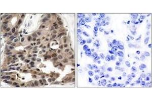 Immunohistochemistry analysis of paraffin-embedded human breast carcinoma tissue, using 4E-BP1 (Ab-36) Antibody. (eIF4EBP1 antibody  (AA 4-53))