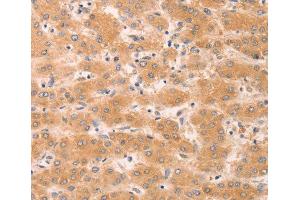 Immunohistochemistry of paraffin-embedded human liver cancer tissue, using GNA11 antibody.