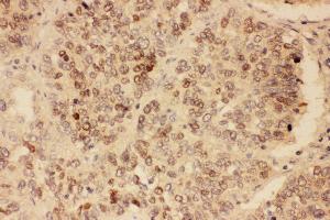 Anti-SOX2 antibody, IHC(P) IHC(P): Human Lung Cancer Tissue (SOX2 antibody  (Middle Region))