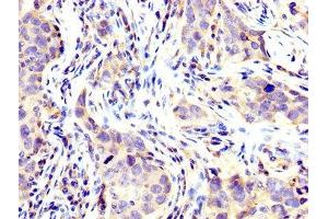 IHC image of ABIN7174344 diluted at 1:200 and staining in paraffin-embedded human pancreatic cancer performed on a Leica BondTM system. (USP48 antibody  (AA 358-508))
