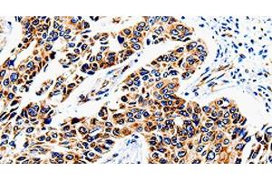 Immunohistochemistry of paraffin-embedded Human lung cancer tissue using COX16 Polyclonal Antibody at dilution 1:50 (COX16 antibody)