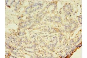 Immunohistochemistry of paraffin-embedded human breast cancer using ABIN7160224 at dilution of 1:100 (SMAD1 antibody  (AA 202-335))