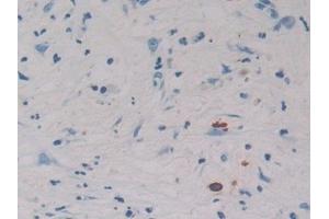 Detection of REG3g in Human Gallbladder Cancer Tissue using Polyclonal Antibody to Regenerating Islet Derived Protein 3 Gamma (REG3g)