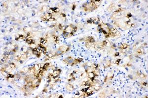 ACSL1 was detected in paraffin-embedded sections of human liver cancer tissues using rabbit anti- ACSL1 Antigen Affinity purified polyclonal antibody (Catalog # ) at 1 µg/mL. (ACSL1 antibody  (AA 604-698))