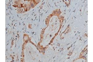ABIN6267287 at 1/50 staining human lung cancer tissue sections by IHC-P. (p53 antibody  (pSer20))