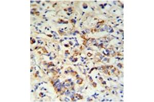 Formalin fixed, paraffin embedded breast carcinoma stained with DCT Antibody (N-term) followed by peroxidase conjugation of the secondary antibody and DAB staining. (DCT antibody  (N-Term))