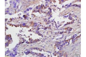 Paraformaldehyde-fixed, paraffin embedded human lung carcinoma, Antigen retrieval by boiling in sodium citrate buffer (pH6) for 15min, Block endogenous peroxidase by 3% hydrogen peroxide for 30 minutes, Blocking buffer (BSA or normal goat serum) at 37°C for 20min, Antibody incubation with Caspase-1 p20 Polyclonal Antibody, Unconjugated  at 1:200 overnight at 4°C, followed by conjugation to the secondary antibody and DAB staining (Caspase 1 p20 antibody  (AA 101-200))